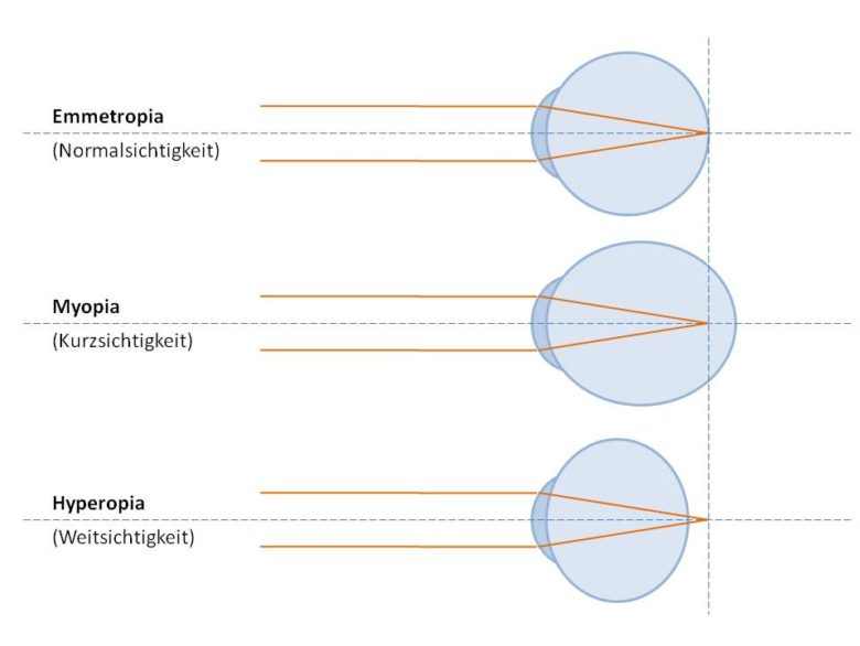 Brille, Kontaktlinse oder LaserOP? DER OPTIK INSPEKTOR